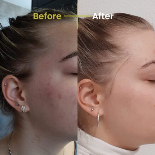 Paris Leaf - Rosacea és Ekcéma elleni arckrém